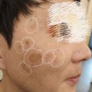 봄한의원 | 부산 흑자 제거 봄 한의원 깜놀 리얼 후기 (흑자투성이 사촌오빠 피부변화기!!)