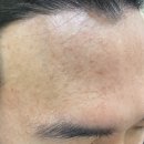 176 | [선릉피부과] “마이미의원” 남자 비립종 제거(176개) 후기