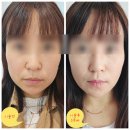 강남비비의원 | 예쁜턱선만들기 턱필러 붓기없는 강남비비의원~