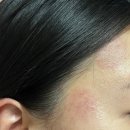 강릉 지변동피부샵 썬바디에스테틱 플라모드 케어 후기