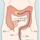 대장내시경 체험기 이미지