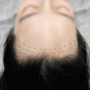 흥미헤어라인 이미지