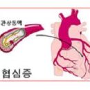 심장 협심증 가슴통증 협심증 전조 이미지