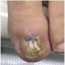 동성대중목욕탕 | 안양 범계 발톱무좀 대만족 관리 후기 미엘네일 동성제약 풀리메디 범계점