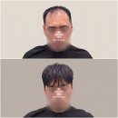 미소헤어샾 - 인제군 | 탈모전문미용실] 남성 정수리, 앞머리 탈모 탈출! '코르셋 헤어증모술'로 감쪽같이 풍성해진 리얼 후기