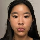 베이비멍 | 신사역피부과 실루엣소프트 실리프팅 베이비리프팅 후기