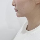 트리플 | 불당동피부과 이중턱 리프팅 텐트리플 내돈내산 후기