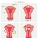 전자궁절제술[Total hysterectomy] 이미지