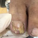 동성(아) | 군포발톱무좀 맞춤 관리 후기 풋네일 동성제약 풀리메디 군포산본점