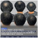 원스칼프 | 부산두피문신 잘하는곳 원스칼프 자신감 찾은 후기