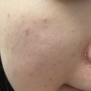 사상고려병원 | 부산 리쥬란 2cc 솔직후기, 사상 피부과에서 탄력 관리 시작