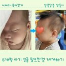 아이엠밀크 | 6개월 아기 커피 밀크 반점 중간 출력 레이저 치료 후기(대전 아이엠 피부과)