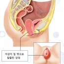 신암카톨릭비뇨기과의원 | 질 튀어나옴? 질 돌출 느껴지는 분은 보세요 <필독>