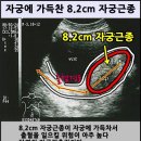 용성장 | 자궁근종 - 경희기린 자궁근종 치료 10대 장점