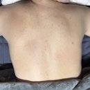 수린약국 | 솔에스테틱 여드름 관리 및 진정케어 후기