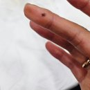 착한 고양이 | 고양이물림 손가락 붓기와 염증 결국 입원까지 한 후기