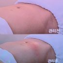 로로케어 | [청라바디관리] 로로에스테틱 / 여름맞이 복부관리 후기