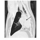 Radiography 및 CT를 이용한 Lobar emphysema의 영상학적 진단 이미지