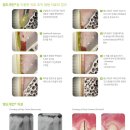 자연치아 살리기 Emdogain (치주 조직 재생 치료제)