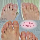 반듯한 멍이 | 마포 대흥 | ‘하이푸스 마포대흥점’ 문제성 발톱 치료 후기