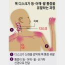 목이 뻣뻣하거나 어깨와 팔 허리~ 이미지