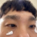 이화가정의원 | 아산천안 피부과 이화가정의학과 비립종레이저 시술 후기