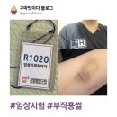 일구팔구튀김 | [여자 생동성] 1박 2일 입원 후기 및 꿀팁 (+준비물, 부작용)