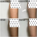 테이핑 및 마사지 | 청담 피부과 바디온다리프팅 후기 주기 통증 및 10만줄 가격 지방분해주사