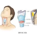 후두암 초기증상 노담이 예방이다 이미지