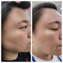인셀덤 보령점 | 난생 처음 인셀덤을 써본 리얼후기