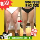이김병원 | [대전] 허벅지 지방흡입 수술 당일 후기...3,900cc 빼고 생긴 일(리얼주의, 준비물, 전후, 통증)