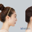 브이라인
