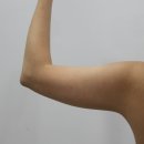 원메디칼 | [팔지방흡입 후기] 다음날 출근, 수술 후 염증, 에덴메디칼 압박복 (당일~2주차 자세한 후기, 사진多)
