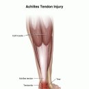 Achilles Tendon Injury 이미지