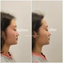 신사동윤곽관리 FACE다이어트 만족스러웠던 압구정에스테틱 허치벨