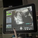 소망하나로병원 | [임신준비] 시험관1차(9) 5일배양 동결배아 이식 D-day 눈사람배아 / 후기추가