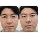 장항동 호반1로-4로 양방향 | 실리프팅 시술전후 차이! 얼굴 반쪽만 해본 후기 - 눈꼬리, 심술보 자보실