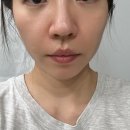 화인사우나 | 강남 피부과 스킨부스터 콜라겐 주사 레디어스 팔자주름 시술 통증 가격 후기 내돈내산