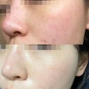 엑스팡 | 내돈내산 기미개선 비올 실펌엑스 후기 : 통증, 다운타임, 색소변화, 모공 (이수역피부과)