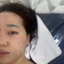 [군자여드름케어] 다나스킨 스킨부스터,약초필 후기