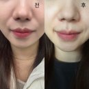 부산 서면 뉴라인성형외과 쥬베룩 볼륨 팔자주름 시술 후기
