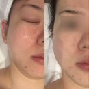 롯데쇼핑(주)롯데마트부평점 | 부평피부관리 추천 강스뷰티 윤곽관리 전후 차이 후기