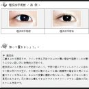의료통역일본어실전편(중급이상)-1.눈의종류(매몰법) 이미지