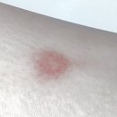 벌레 물린 곳에 간편하게! 유한양행 해피홈 쿨액 롤온 사용 후기, 여름 필수템 추천
