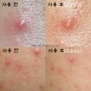 [소망화장품] 아크프리 (외용액/일반의약품) 여드름 스팟! 여드름엔 톡톡톡!