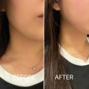 글로비다 | 압구정 글로비안티에이징센터 크레이지015 후기 | 스티키 각질필링부터 리프팅 관리까지