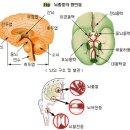 뇌졸중 이미지