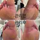 광주 내성발톱 문제성발 발각질 관리 케어 전문 네일샵 병원 없이 관리하는 꿀TIP #광산구 이미지