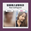 더탑성형외과의원 네이버블로그