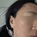 창원 피부과 프락셀 라비앙 레이저 + 아기앰플 2cc 내돈내산